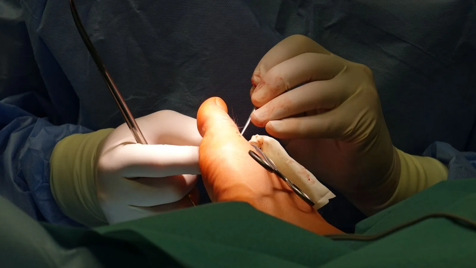 What to Expect at a Bunion Evaluation